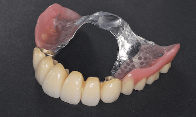 義歯(入れ歯)治療